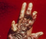 fullhudsbrännskada